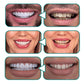 Snap-On Smile