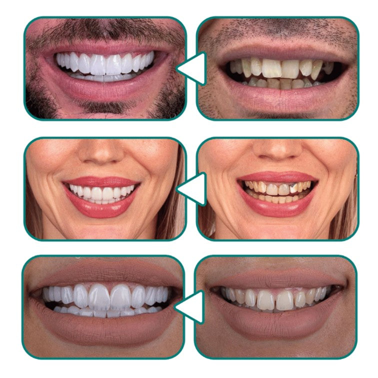 Snap-On Smile
